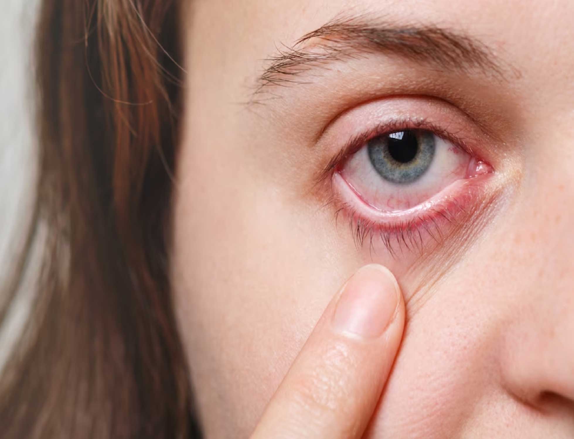 Glaucoma Day